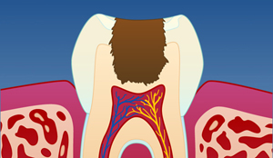 Trinnvis ekskavering