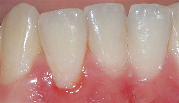 gingivitt Pasient 1 1