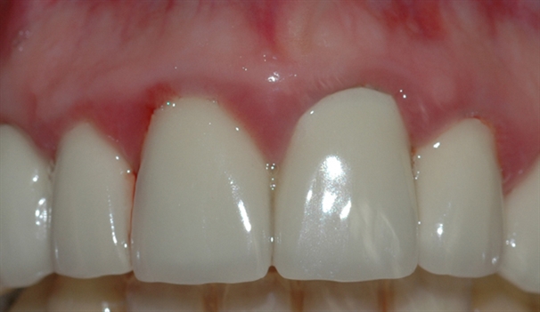 gingivitt pasient 2 1