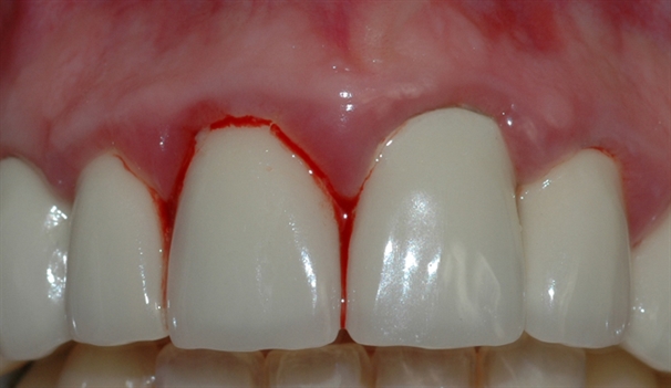 gingivitt pasient 2 2