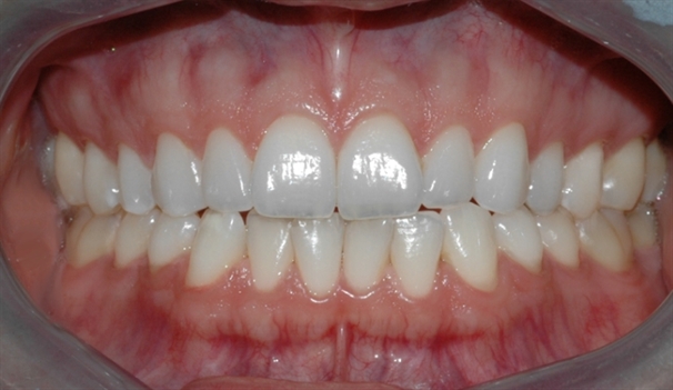 bleking_pasient_1_etter