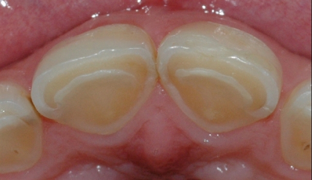 syreskader front palatinalt